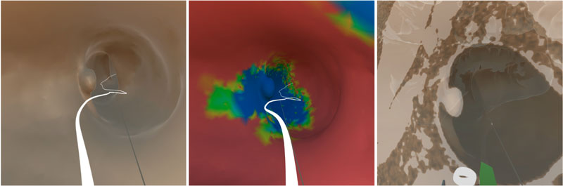 Figure 1. Highlights of the immersive colonoscopy viewer. In (a), a view from inside the colon in VR shows a medial axis line in white. (b) colourmap view of eye-tracked data, indicating the areas already examined in blue and not yet seen in red. (c) CT data plane visible in situ, where the tissue density can be inspected to help detect disease. 