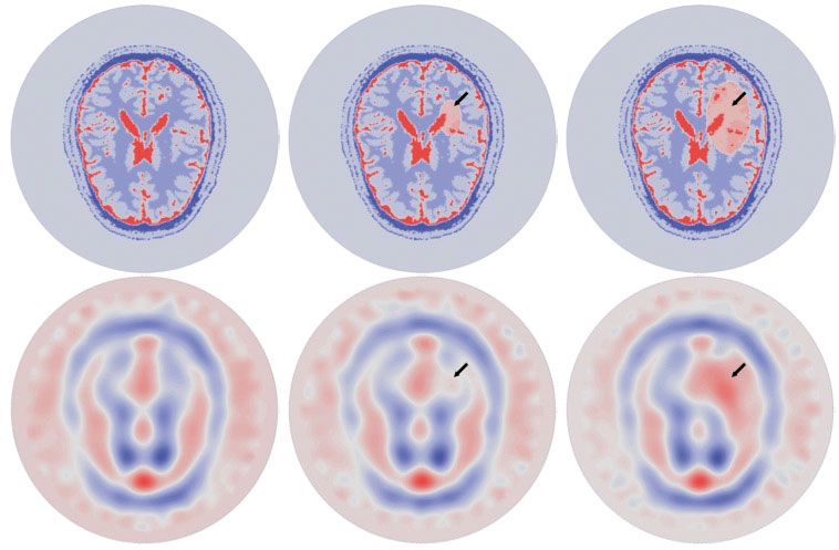 Figure 3: Imaginary part of the permittivity during the evolution of a simulated hemorrhagic CVA (from left to right: healthy brain, small CVA, large CVA). Top row: exact virtual brain model. Bottom row: reconstructed permittivity.