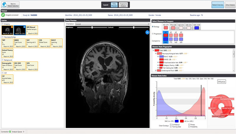 Figure 1: A screenshot of the decision support tool. On the left-hand side the different information sources are shown, including, in this example, MRI imaging data, neuropsychological test results, background information and cerebrospinal fluid (CSF) data. The middle panel shows the image analysis view which allows for automatic segmentation, quantification and visualisation of relevant parts of the brain. The right hand panel shows the multi-variate decision support functionality. At the top, the various forms of dementia that can be considered are shown, below is a “disease state fingerprint” indicating visually and quantitatively to which disease group this patient most likely belongs, together with the relative importance of the different variables. Finally, the raw data distributions of separate variables can be examined in the bottom right panel.