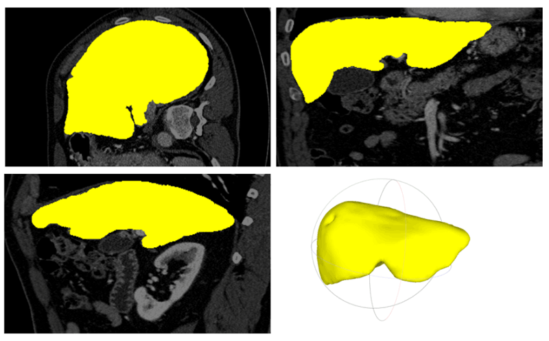 Figure 1: Liver segmentation and 3D modelling on CT data: Segmentation result in axial, coronal, sagittal view and the rendered 3D model of the liver.