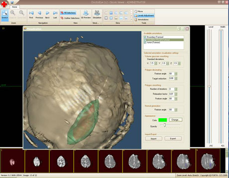 Figure 1: An example of visualizing the simulated tumor in brain, using the DoctorEye Tool, after 65 days of evolution. The initial tumor is reddish, while the simulated tumor is greenish.