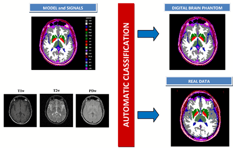 Figure 1: A single slice of the digital brain phantom and the corresponding MRI T1W, T2W and PDW signals (left), automatic tissue classification obtained (right).