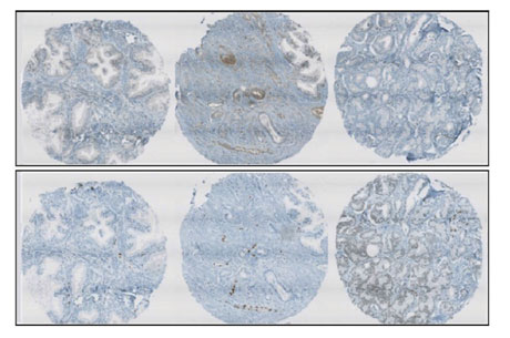 Figure 1: IHC prostate images indicating the difficulty of sample analysis. Emphasizing the PTEN (top) and ERG (bottom) proteins. Left to right: normal, low, and intermediate grade stages of cancer development. Figure taken from Zerhouni et al [3].