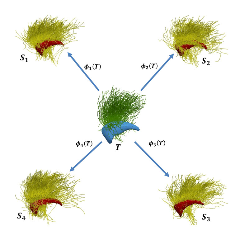 Figure 1: Modelling of brain structure. An average model (called template, denoted as T) is estimated from a population of subjects Si. Each subject is seen as the deformation Φi(T) of the template. The model includes both grey matter structures (surfaces extracted from anatomical MRI) and white matter tracks (curves extracted from diffusion MRI). For the sake of visualisation, only one surface and a set of curves are displayed on the figure.