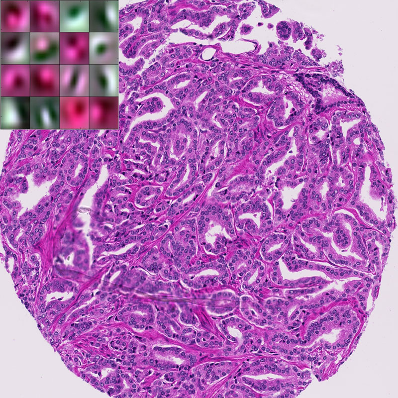 Figure 1: Example of H&E stained prostate tissue with a subset of the learned filters.