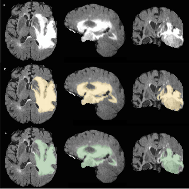 Figure 1: Figure 1: Results of segmentation of GTV for TCIA 471 patient: a) FLAIR acquisition b) Manual segmentation (BRATS 17 dataset) c) Segmentation result performed with VoxLogicA.