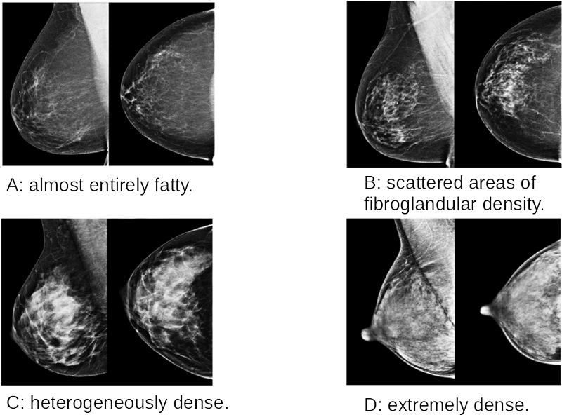 Figure 1: The four density classes are shown as reported in the BI-RADS Atlas. The classes are defined through textual description and examples and are named A, B, C and D in order of increasing density.