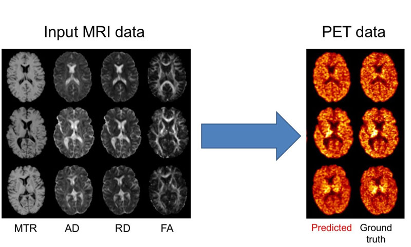 Figure 1: Prediction of myelin content, as defined from PET images, using multiple MRI modalities. On the left, input MRI modalities: magnetisation transfer ratio (MTR) and three measures computed from diffusion MRI, axial diffusivity (AD), radial diffusivity (RD) and fractional anisotropy (FA). On the right: predicted and ground truth PET data. The PET tracer is the Pittsburgh compound B (PiB) is used to measure myelin content in the white matter of the brain.