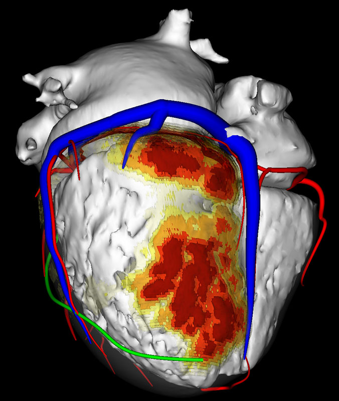 Figure 1: 3D rendering of the cardiac atria and ventricles (white), veins (blue), coronaries (red), phrenic nerve (green) from CT and fibrosis quantification (yellow to red) from MRI. This detailed information provides structures to avoid (vessels, nerves) and areas to treat (fibrosis) when performing catheter ablation of arrhythmias.