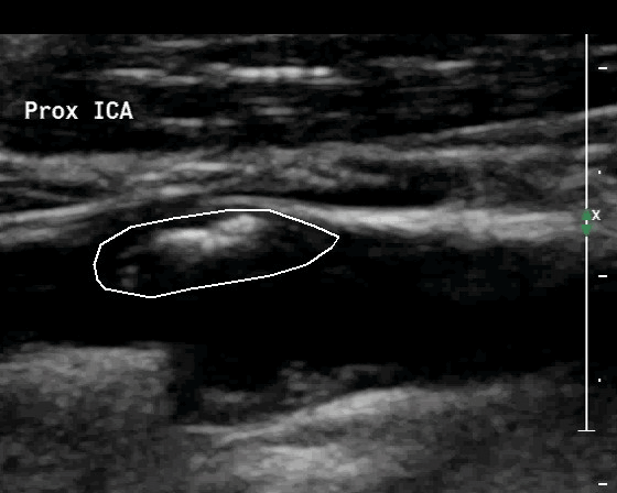 Figure 1: Original (uncompressed) ultrasound video image example of the internal carotid artery (ICA). The straight white line delineates the atherosclerotic plaque causing stenosis. Video resolution: 560 × 448, frame rate: 40 fps.