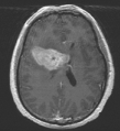Figure 1: 2D CT brain image: position of the tumour is visible as a shadow.