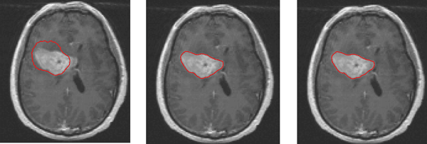 Figure 2: Contour representation of the tumour based on active contour models. From left to right:  20 iterations, 50 iterations, 100 iterations.