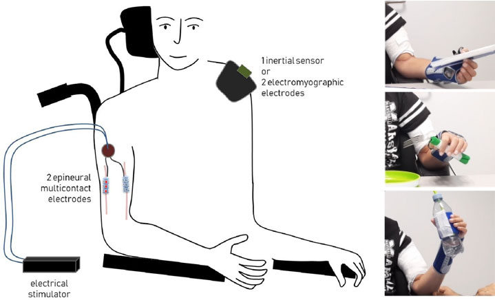 Figure 1: Left: AGILIS solution: two multi-contact neural stimulation electrodes are wrapped around medial and radial nerves. The user mobilises his/her sus-lesional muscles to send orders to the controller of the electrical stimulator to activate the corresponding electrode configuration and induce the intended hand action. Right: Examples of object grasping.