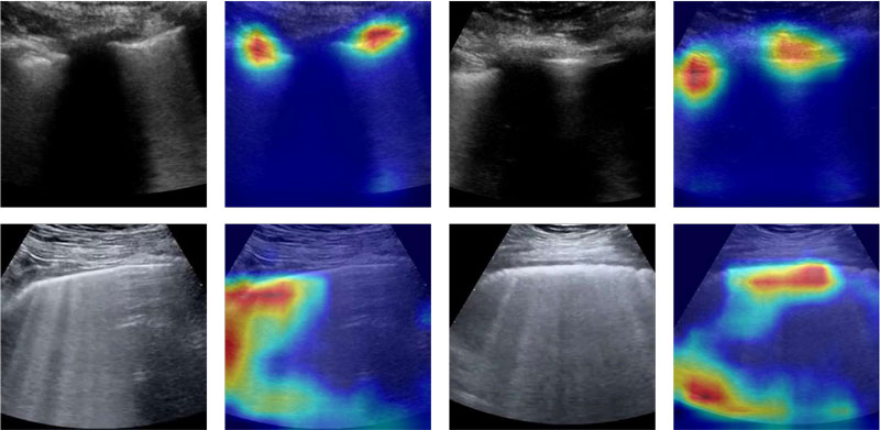 Figure 1: COVID-19 – Original and Grad-CAM-processed samples are shown for subjects with COVID-19; different images within different subjects show similar activation maps.