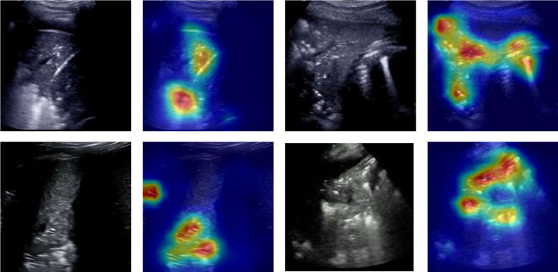 Figure 2: Pneumonia – Original and Grad-CAM-processed samples are shown for subjects with pneumonia; the attention of the classifier is on different regions of the images in contrast to the other two classes.