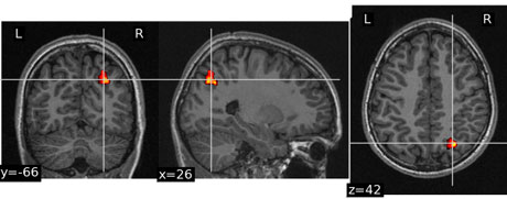 Figure 1: Identifying areas in the human brain (hot colors) in which activation is correlated with a given SNP  data, using A-Brain.