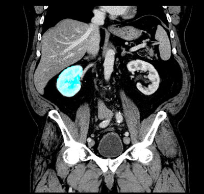 Figure 1: Raw segmentation of the right kidney